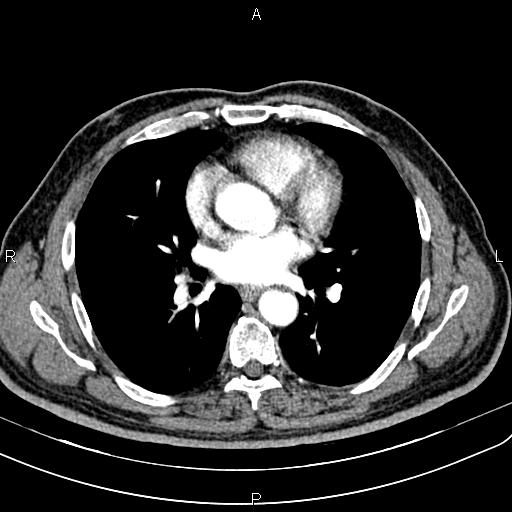 File:Cecal cancer with appendiceal mucocele (Radiopaedia 91080-108651 A 37).jpg