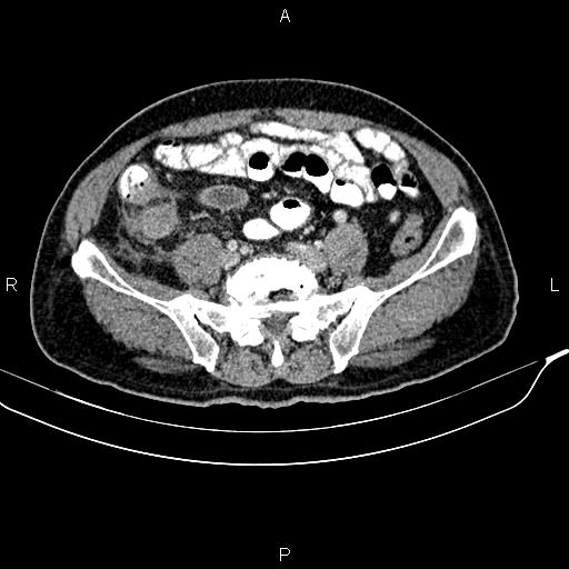 File:Cecal cancer with appendiceal mucocele (Radiopaedia 91080-108651 B 75).jpg