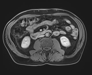 Cecal mass causing appendicitis (Radiopaedia 59207-66532 J 72).jpg