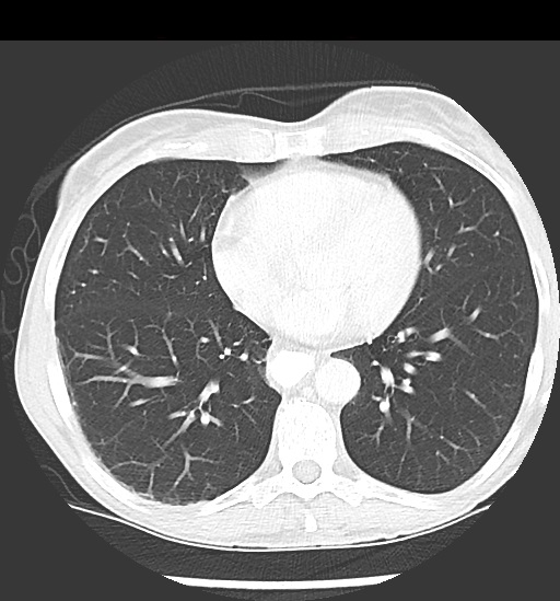File:Cecal volvulus (Radiopaedia 48543-53513 Axial lung window 3).jpg