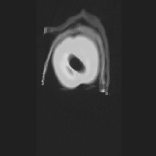 Cecal volvulus (Radiopaedia 75378-86620 Coronal lung window 9).jpg
