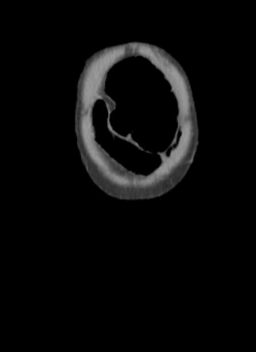 Cecal volvulus with pneumatosis coli (Radiopaedia 68572-78178 B 72).jpg