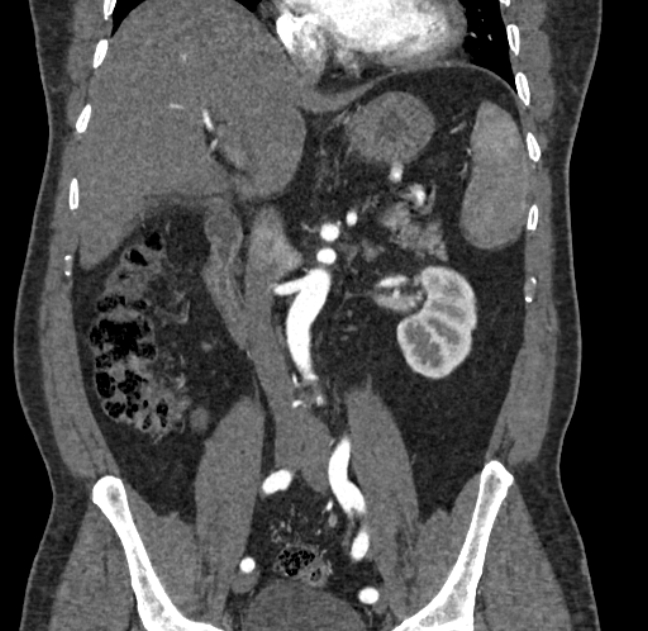 Celiac artery dissection (Radiopaedia 52194-58080 C 60).jpg
