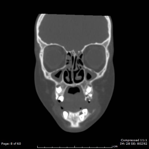 Central giant cell granuloma (Radiopaedia 45612-49754 Coronal bone window 8).jpg