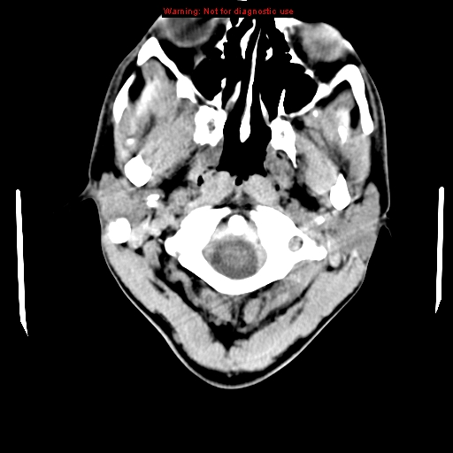 File:Central nervous system vasculitis (Radiopaedia 8410-9234 Axial non-contrast 1).jpg
