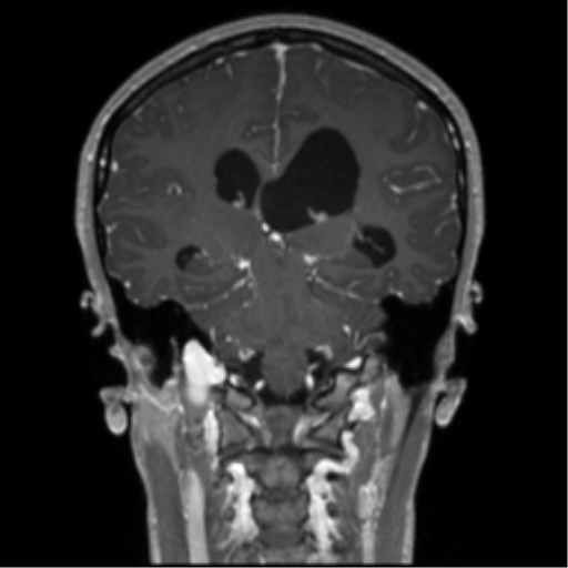 Central neurocytoma (Radiopaedia 37664-39557 Coronal T1 C+ 36).png