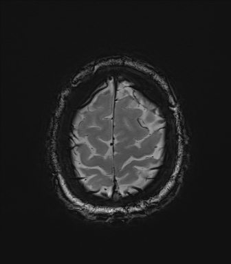 Central neurocytoma (Radiopaedia 71068-81303 Axial SWI 60).jpg