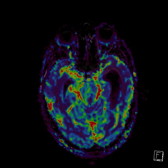 Central neurocytoma (Radiopaedia 84497-99872 Axial Perfusion 205).jpg