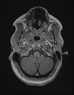 File:Central neurocytoma (Radiopaedia 84497-99872 Axial T1 34).jpg