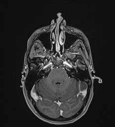 Central neurocytoma (Radiopaedia 84497-99872 Axial T1 C+ 42).jpg