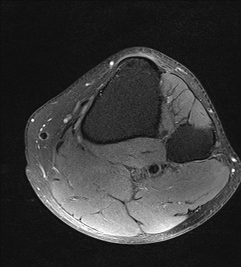 File:Central osteophyte (Radiopaedia 72592-83150 Axial PD fat sat 36).jpg