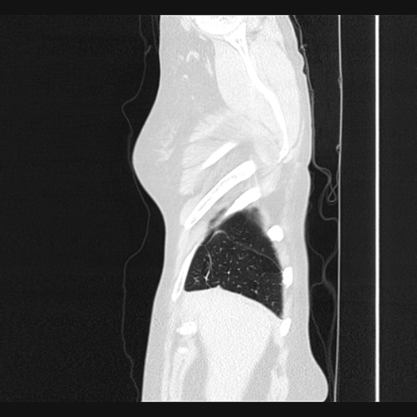 Centrilobular pulmonary emphysema (Radiopaedia 24495-24789 Sagittal lung window 6).jpg