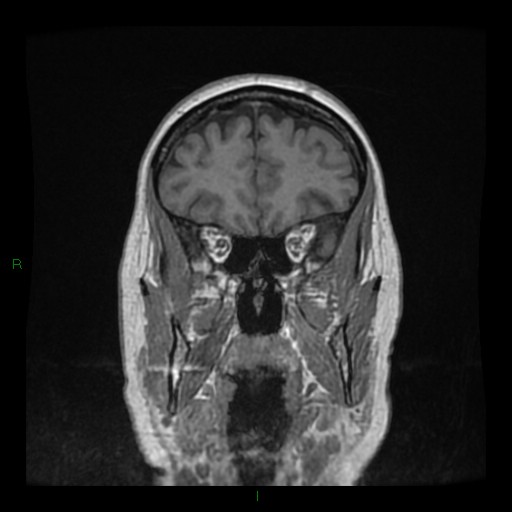 Cerebellar abscess (Radiopaedia 78135-90678 Coronal T1 C+ 41).jpg