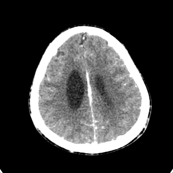 Cerebellar abscess secondary to mastoiditis (Radiopaedia 26284-26412 Axial C+ delayed 119).jpg