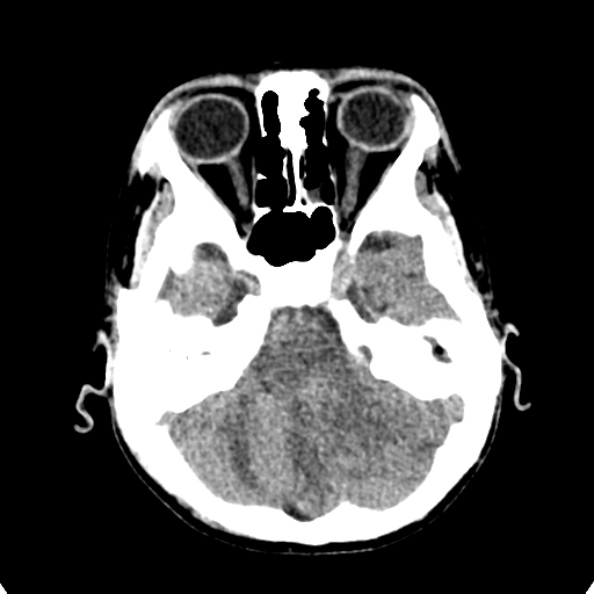 Cerebellar abscess secondary to mastoiditis (Radiopaedia 26284-26412 Axial non-contrast 35).jpg