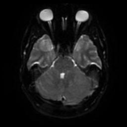 Cerebellar hemangioblastoma (Radiopaedia 29570-30077 Axial DWI 35).jpg