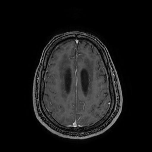 File:Cerebellar hemangioblastoma (Radiopaedia 88055-104622 Axial T1 C+ 132).jpg