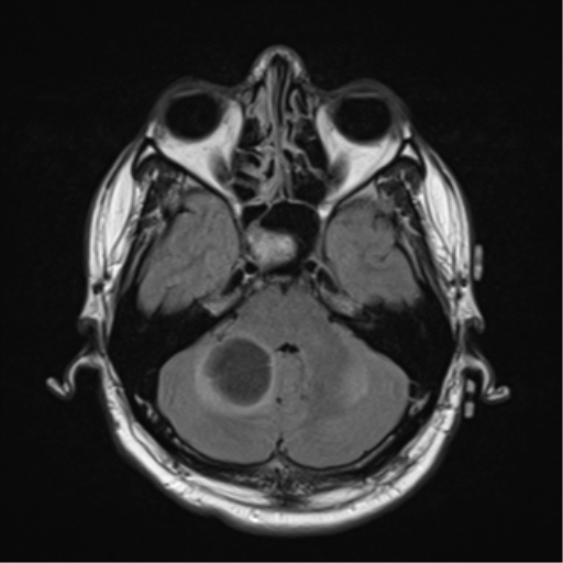 File:Cerebellar hemangioblastomas and pituitary adenoma (Radiopaedia 85490-101176 Axial FLAIR 8).png