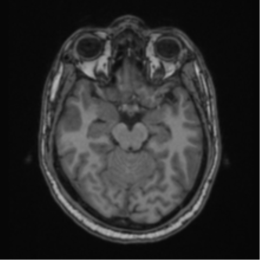 Cerebellar hemangioblastomas and pituitary adenoma (Radiopaedia 85490-101176 Axial T1 29).png
