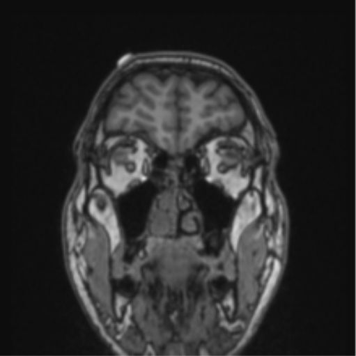 File:Cerebellar hemangioblastomas and pituitary adenoma (Radiopaedia 85490-101176 Coronal T1 76).png