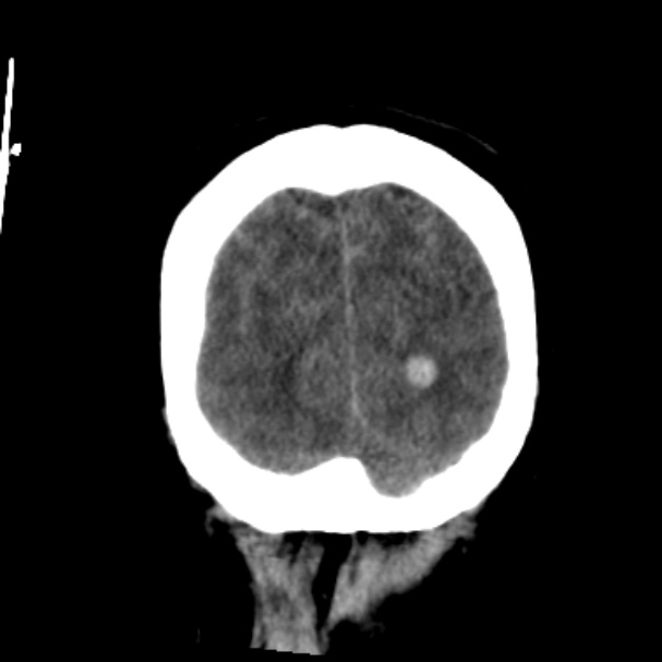 Cerebellar hemorrhage causing obstructive hydrocephalus (Radiopaedia 33989-35207 Coronal non-contrast 48).jpg