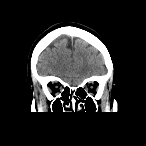 Cerebellar metastasis (cystic appearance) (Radiopaedia 41395-44258 Coronal non-contrast 17).png