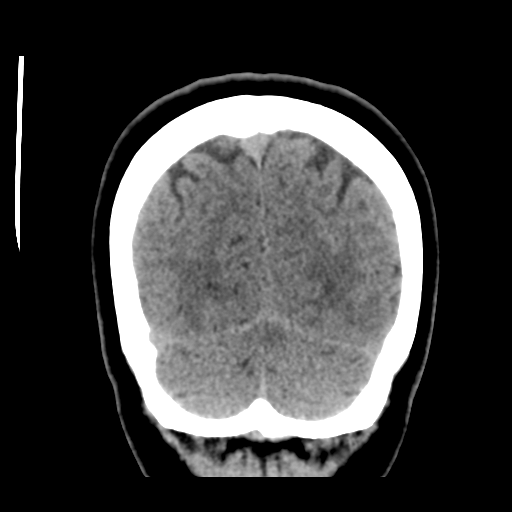 Cerebellar metastasis (cystic appearance) (Radiopaedia 41395-44258 Coronal non-contrast 51).png