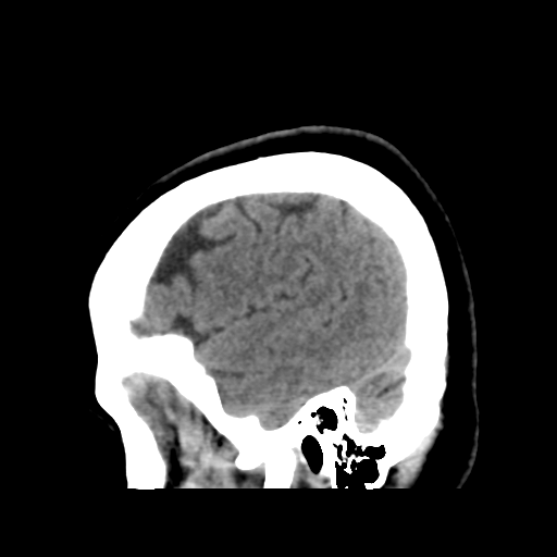 File:Cerebellar metastasis (cystic appearance) (Radiopaedia 41395-44258 E 13).png