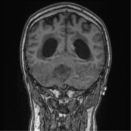 Cerebellar metastasis from lung adenocarcinoma (Radiopaedia 86690-102829 Coronal T1 33).png
