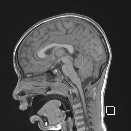 File:Cerebellar stroke (Radiopaedia 32202-33150 Sagittal T1 C+ 27).png