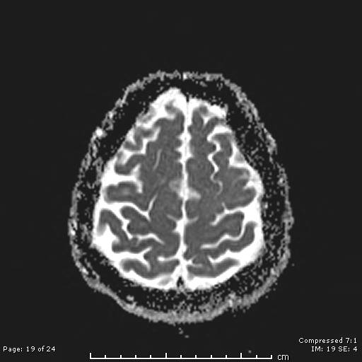 File:Cerebellar strokes due to intracranial giant cell arteritis (Radiopaedia 68799-81713 Axial ADC 19).jpg