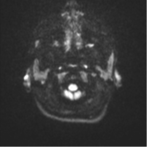 Cerebellar tuberculomas (Radiopaedia 46939-51472 Axial DWI 30).png