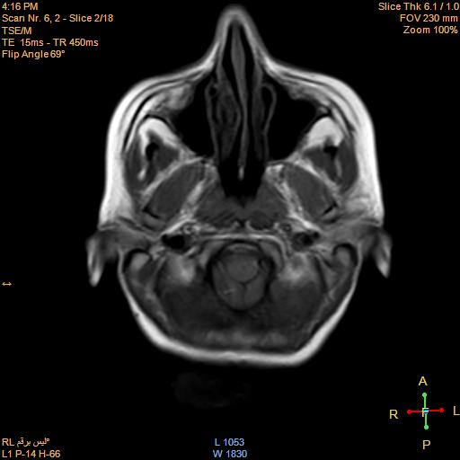File:Cerebellopontine angle meningioma (Radiopaedia 22488-22525 Axial T1 1).jpg