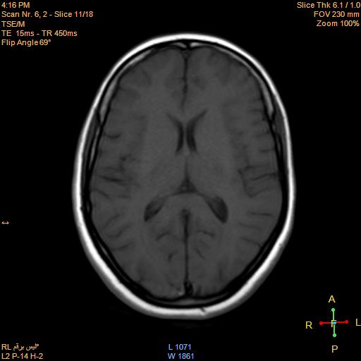 File:Cerebellopontine angle meningioma (Radiopaedia 22488-22525 Axial T1 10).jpg