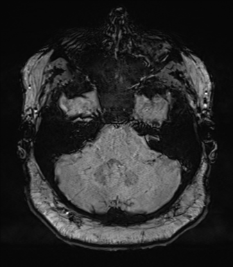 File:Cerebellopontine angle meningioma (Radiopaedia 48434-53348 Axial SWI 22).png