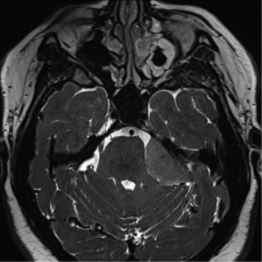 Cerebellopontine angle meningioma (Radiopaedia 48434-53348 Axial T2 Space 69).png