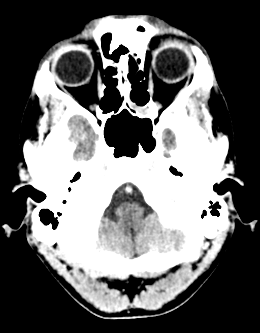 Cerebral abscess (Radiopaedia 60342-68008 Axial C+ delayed 9).png