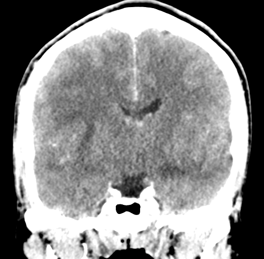 File:Cerebral abscess (Radiopaedia 60342-68008 Coronal C+ delayed 33).png