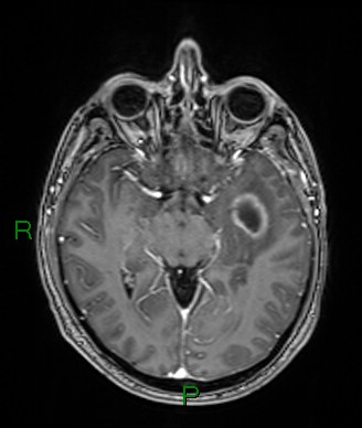 Cerebral abscess and subdural empyema (Radiopaedia 84436-99779 Axial T1 C+ 50).jpg