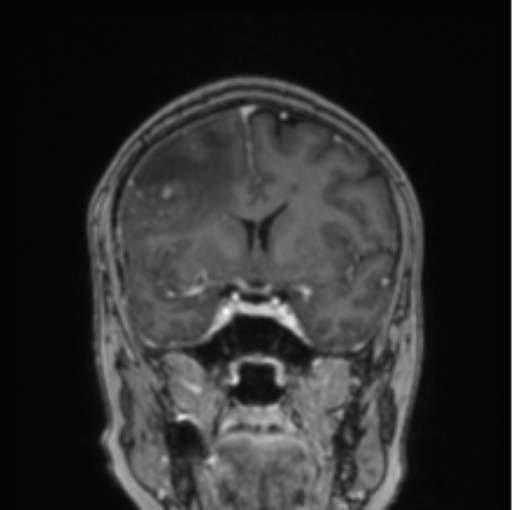 Cerebral abscess from pulmonary arteriovenous malformation (Radiopaedia 86275-102291 L 56).png