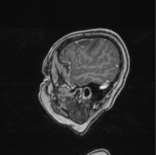 Cerebral abscess from pulmonary arteriovenous malformation (Radiopaedia 86275-102291 Sagittal T1 C+ 66).png