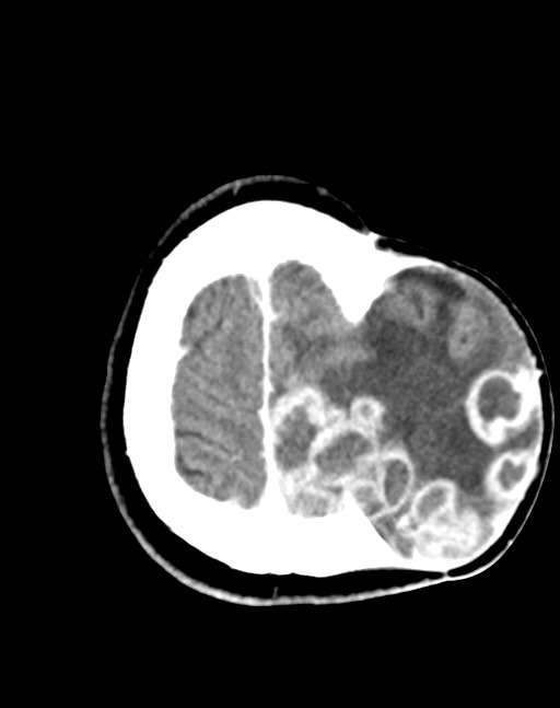 Cerebral abscesses (Radiopaedia 70458-80568 Axial Contrast 52).jpg