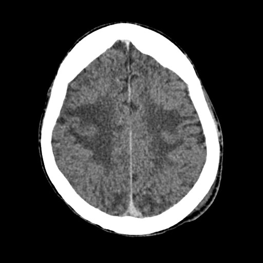 Cerebral amyloid angiopathy-related inflammation (Radiopaedia 74836-85848 Axial non-contrast 44).jpg