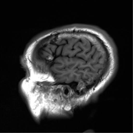 File:Cerebral amyloid angiopathy (Radiopaedia 46082-50433 Sagittal T1 3).png