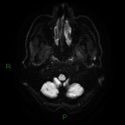 Cerebral amyloid angiopathy (Radiopaedia 77506-89664 Axial DWI 4).jpg