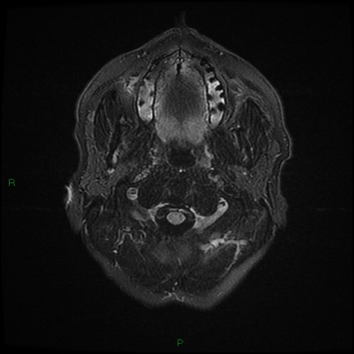 File:Cerebral amyloid angiopathy (Radiopaedia 77506-89664 Axial FLAIR 1).jpg