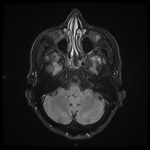 File:Cerebral amyloid angiopathy (Radiopaedia 77506-89664 Axial FLAIR 7).jpg