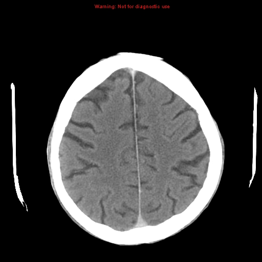 File:Cerebral and orbital tuberculomas (Radiopaedia 13308-13310 B 22).jpg