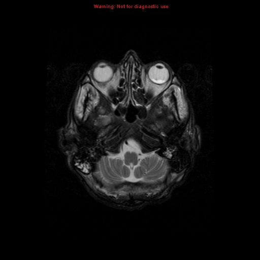 File:Cerebral and orbital tuberculomas (Radiopaedia 13308-13311 Axial T2 4).jpg