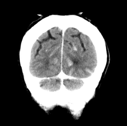 File:Cerebral aneurysm with rupture (Radiopaedia 29933-30460 Coronal non-contrast 32).jpg